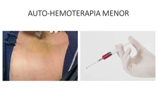 AUTO-HEMOTERAPIA MENOR
 