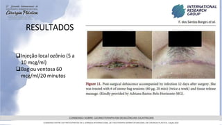 GRAMADO,AGOSTOde 2022
CONSENSO SOBRE OZONIOTERAPIA EM DEISCÊNCIAS CICATRICIAS
CONSENSO ENTRE OS PARTICIPANTES DA 5 JORNADA INTERNACIONAL DE FISIOTERAPIA DERMATOFUNCIONAL EM CIRURGIA PLASTICA, Edição 2022
RESULTADOS
Injeção local ozônio (5 a
10 mcg/ml)
Bag ou ventosa 60
mcg/ml/20 minutos
 
