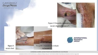 GRAMADO,AGOSTOde 2022
CONSENSO SOBRE OZONIOTERAPIA EM DEISCÊNCIAS CICATRICIAS
CONSENSO ENTRE OS PARTICIPANTES DA 5 JORNADA INTERNACIONAL DE FISIOTERAPIA DERMATOFUNCIONAL EM CIRURGIA PLASTICA, Edição 2022
 