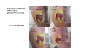 AVALIAÇÃO SEMANAL DE
TRATAMENTO
DOMICILIAR COM OLEO
TOTAL: 08 SEMANAS
 