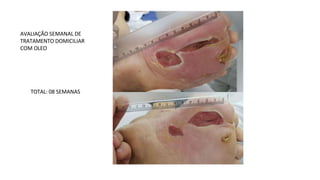 AVALIAÇÃO SEMANAL DE
TRATAMENTO DOMICILIAR
COM OLEO
TOTAL: 08 SEMANAS
 