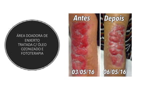 ÁREA DOADORA DE
ENXERTO
TRATADA C/ ÓLEO
OZONIZADO E
FOTOTERAPIA
 