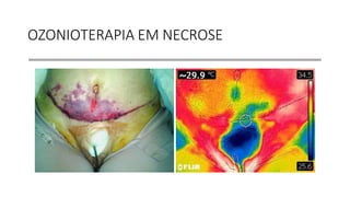 OZONIOTERAPIA EM NECROSE
 