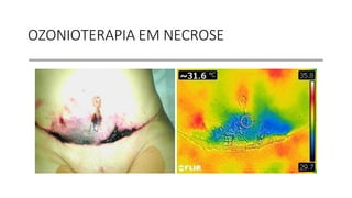 OZONIOTERAPIA EM NECROSE
 