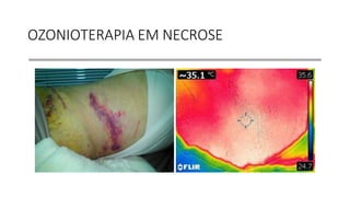 OZONIOTERAPIA EM NECROSE
 