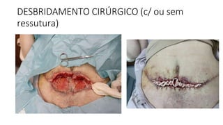 DESBRIDAMENTO CIRÚRGICO (c/ ou sem
ressutura)
 