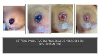 ESTÁGIO EVOLUTIVO DO PROCESSO DE NECROSE SEM
DESBRIDAMENTO
 