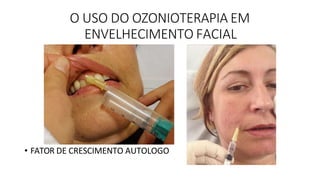 O USO DO OZONIOTERAPIA EM
ENVELHECIMENTO FACIAL
• FATOR DE CRESCIMENTO AUTOLOGO
 
