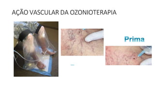 AÇÃO VASCULAR DA OZONIOTERAPIA
 