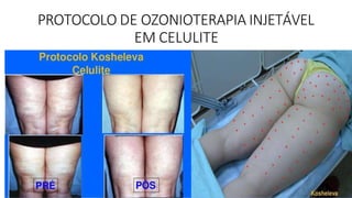 PROTOCOLO DE OZONIOTERAPIA INJETÁVEL
EM CELULITE
 