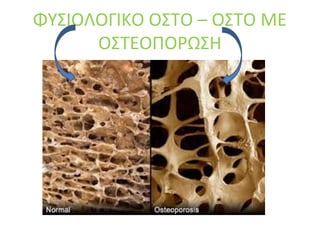 ΦΥΣΙΟΛΟΓΙΚΟ ΟΣΤΟ – ΟΣΤΟ ΜΕ
ΟΣΤΕΟΠΟΡΩΣΗ
 