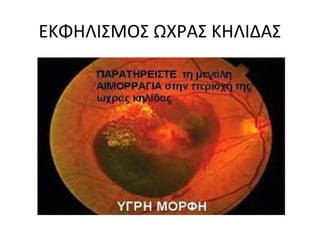 ΕΚΦΗΛΙΣΜΟΣ ΩΧΡΑΣ ΚΗΛΙΔΑΣ
 