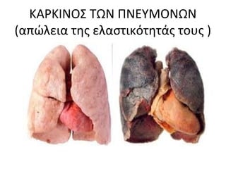 ΚΑΡΚΙΝΟΣ ΤΩΝ ΠΝΕΥΜΟΝΩΝ
(απώλεια της ελαστικότητάς τους )
 