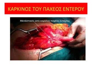 ΚΑΡΚΙΝΟΣ ΤΟΥ ΠΑΧΕΟΣ ΕΝΤΕΡΟΥ
 