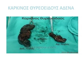 ΚΑΡΚΙΝΟΣ ΘΥΡΕΟΕΙΔΟΥΣ ΑΔΕΝΑ
 