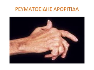 ΡΕΥΜΑΤΟΕΙΔΗΣ ΑΡΘΡΙΤΙΔΑ
 