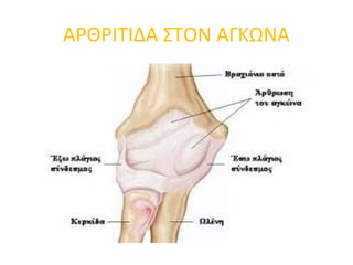 ΑΡΘΡΙΤΙΔΑ ΣΤΟΝ ΑΓΚΩΝΑ
 