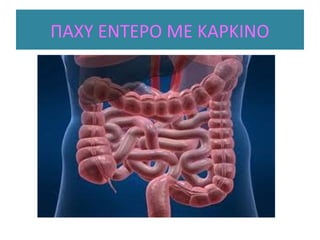 ΠΑΧΥ ΕΝΤΕΡΟ ΜΕ ΚΑΡΚΙΝΟ
 