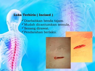 Luka Terhiris ( Incised )Luka Terhiris ( Incised )
Disebabkan benda tajam.
Mudah dicantumkan semula.
Senang dirawat.
Pendarahan berlaku.
 