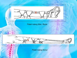 X
X
Patah tulang tibia / fibula
Patah tulang femur
 