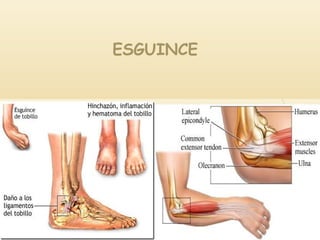 ESGUINCE
 