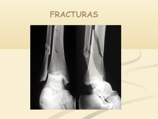 FRACTURAS
 