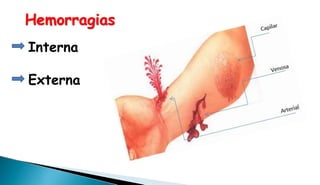 Hemorragias
Interna
Externa
 