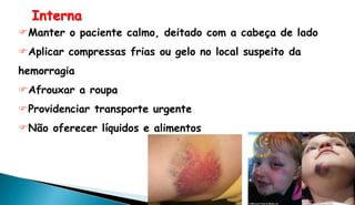 Interna
Manter o paciente calmo, deitado com a cabeça de lado
Aplicar compressas frias ou gelo no local suspeito da
hemorragia
Afrouxar a roupa
Providenciar transporte urgente
Não oferecer líquidos e alimentos
 