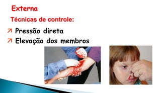 Externa
 Pressão direta
 Elevação dos membros
Técnicas de controle:
 