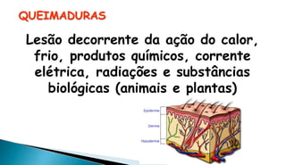 QUEIMADURAS
Lesão decorrente da ação do calor,
frio, produtos químicos, corrente
elétrica, radiações e substâncias
biológicas (animais e plantas)
 