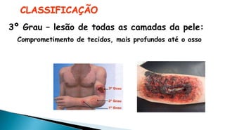 CLASSIFICAÇÃO
3º Grau – lesão de todas as camadas da pele:
Comprometimento de tecidos, mais profundos até o osso
 