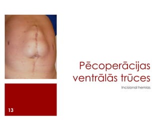 Pēcoperācijas
ventrālās trūces
Incisional hernias

13

 