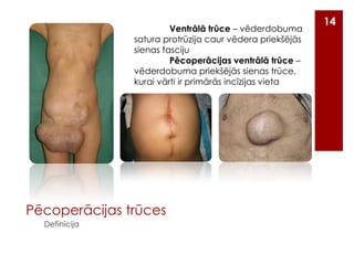 Ventrālā trūce – vēderdobuma
satura protrūzija caur vēdera priekšējās
sienas fasciju
Pēcoperācijas ventrālā trūce –
vēderdobuma priekšējās sienas trūce,
kurai vārti ir primārās incīzijas vieta

Pēcoperācijas trūces
Definīcija

14

 