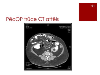 21

PēcOP trūce CT attēls

 