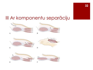 32

III Ar komponentu separāciju

 