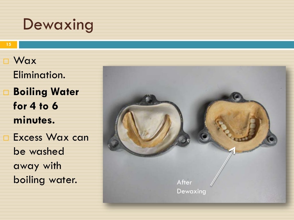 Removeable Partial Denture Steps