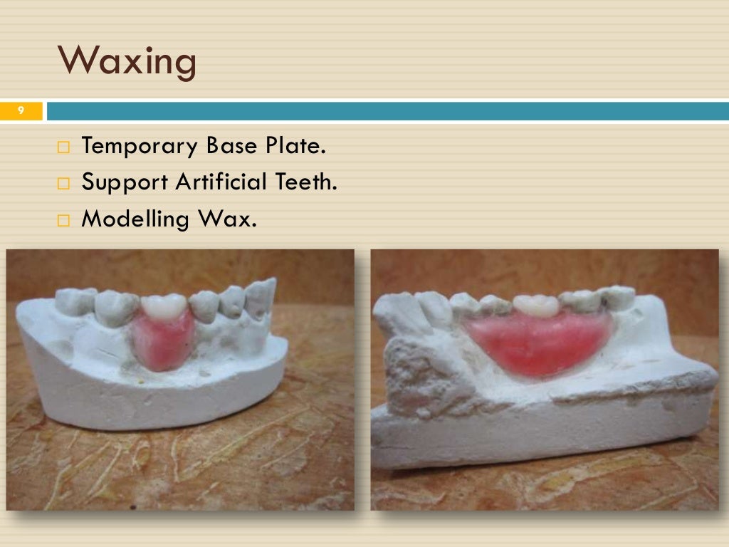 Removeable Partial Denture Steps