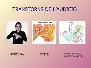 TRANSTORNS DE L’AUDICIÓ SORDESA OTITIS OBSTRUCCIÓ DEL CONDUCTE AUDITIU 
