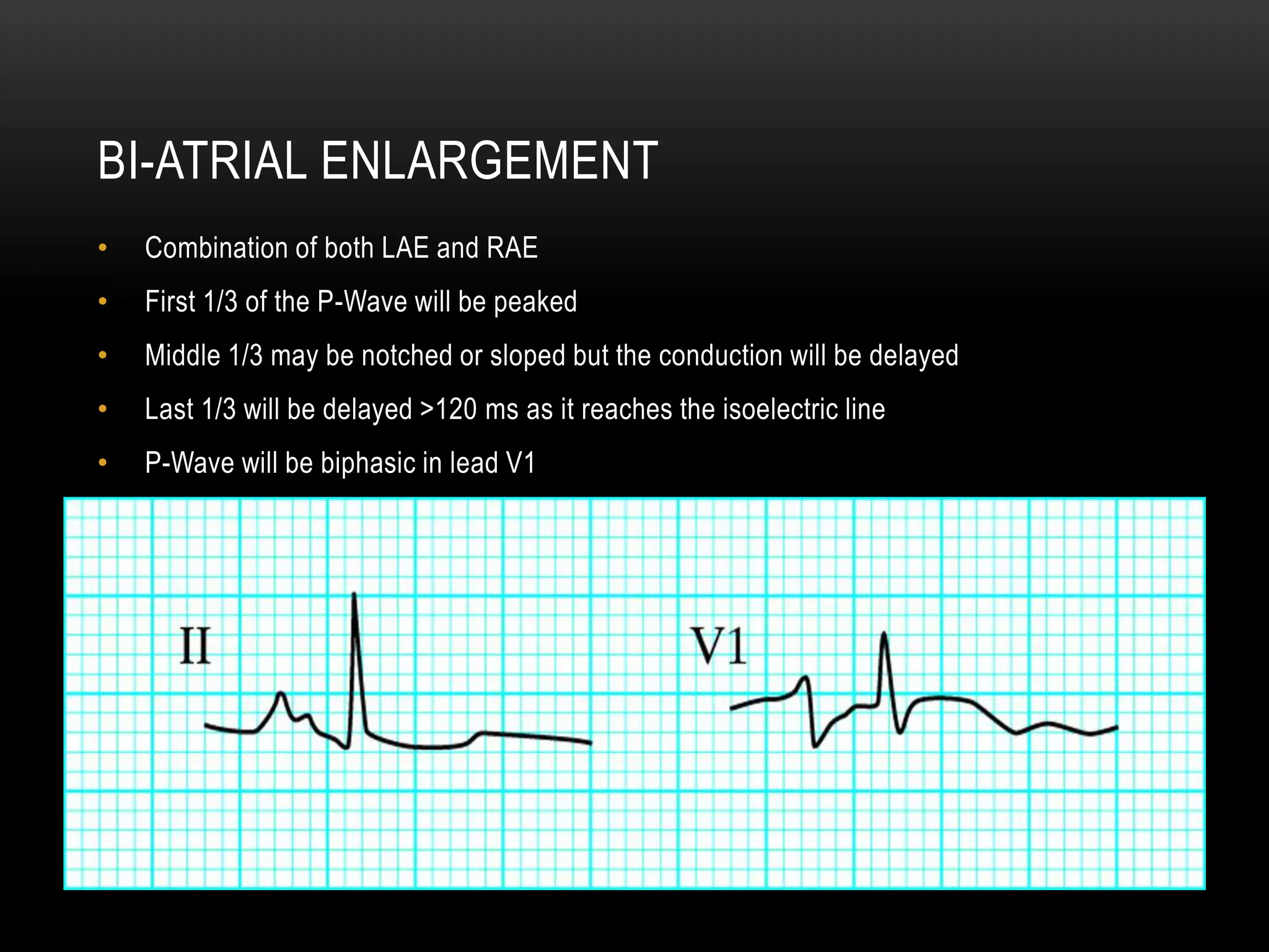 P wave axis and escape rhythms | PPTX