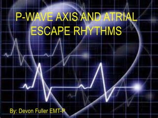 By: Devon Fuller EMT-P
P-WAVE AXIS AND ATRIAL
ESCAPE RHYTHMS
 