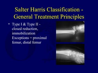 Salter Harris Classification -
General Treatment Principles
• Type I & Type II -
closed reduction,
immobilization
Exceptions = proximal
femur, distal femur
 