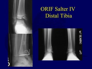 ORIF Salter IV
Distal Tibia
 