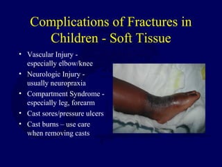 Complications of Fractures in
Children - Soft Tissue
• Vascular Injury -
especially elbow/knee
• Neurologic Injury -
usually neuropraxia
• Compartment Syndrome -
especially leg, forearm
• Cast sores/pressure ulcers
• Cast burns – use care
when removing casts
 