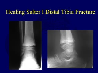 Healing Salter I Distal Tibia Fracture
 