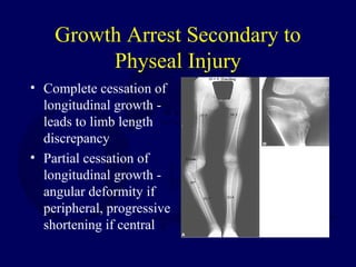 Growth Arrest Secondary to
Physeal Injury
• Complete cessation of
longitudinal growth -
leads to limb length
discrepancy
• Partial cessation of
longitudinal growth -
angular deformity if
peripheral, progressive
shortening if central
 
