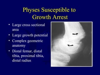 Physes Susceptible to
Growth Arrest
• Large cross sectional
area
• Large growth potential
• Complex geometric
anatomy
• Distal femur, distal
tibia, proximal tibia,
distal radius
 