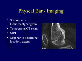 Physeal Bar - Imaging
• Scanogram /
Orthoroentgenogram
• Tomograms/CT scans
• MRI
• Map bar to determine
location, extent
 
