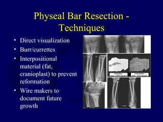 Physeal Bar Resection -
Techniques
• Direct visualization
• Burr/currettes
• Interpositional
material (fat,
cranioplast) to prevent
reformation
• Wire makers to
document future
growth
 