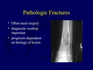 Pathologic Fractures
• Often need surgery
• diagnostic workup
important
• prognosis dependent
on biology of lesion
 
