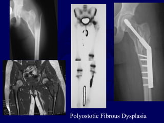 Polyostotic Fibrous Dysplasia
 
